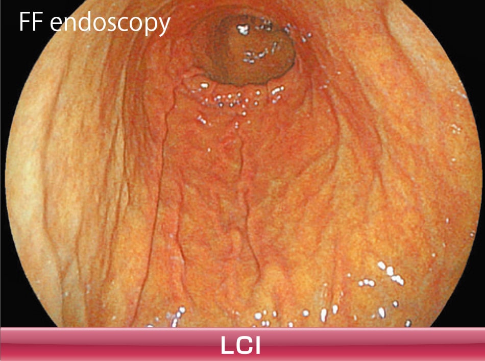 「LCI（Linked Color Imaging）」画像
