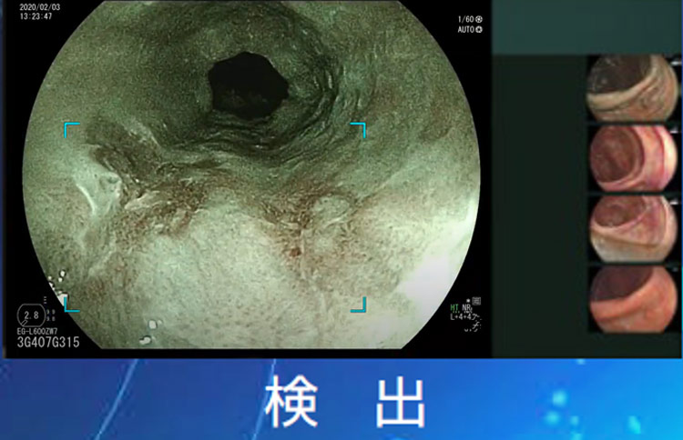 食道扁平上皮癌疑い検出