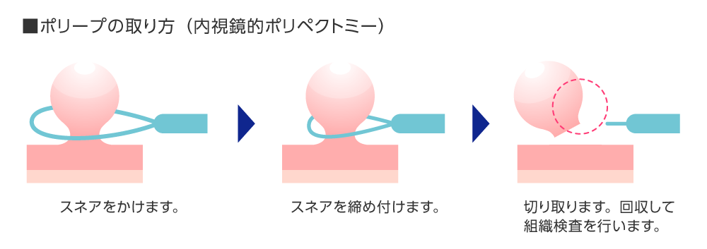 ポリープの取り方（内視鏡的ポリペクトミー）　スネアをかけます→スネアを締め付けます。→切り取ります。回収して組織検査を行います。